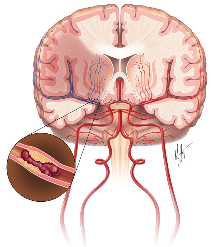Ischemic