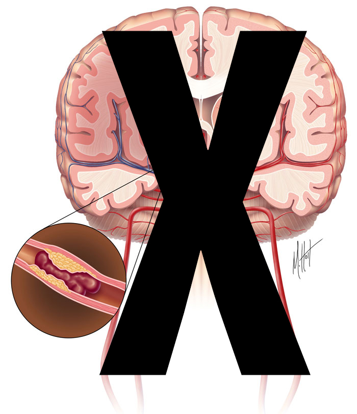 Ischemic